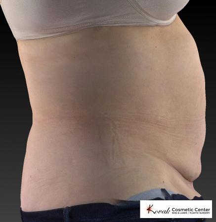 CoolSculpting®: Patient 8 - After 4