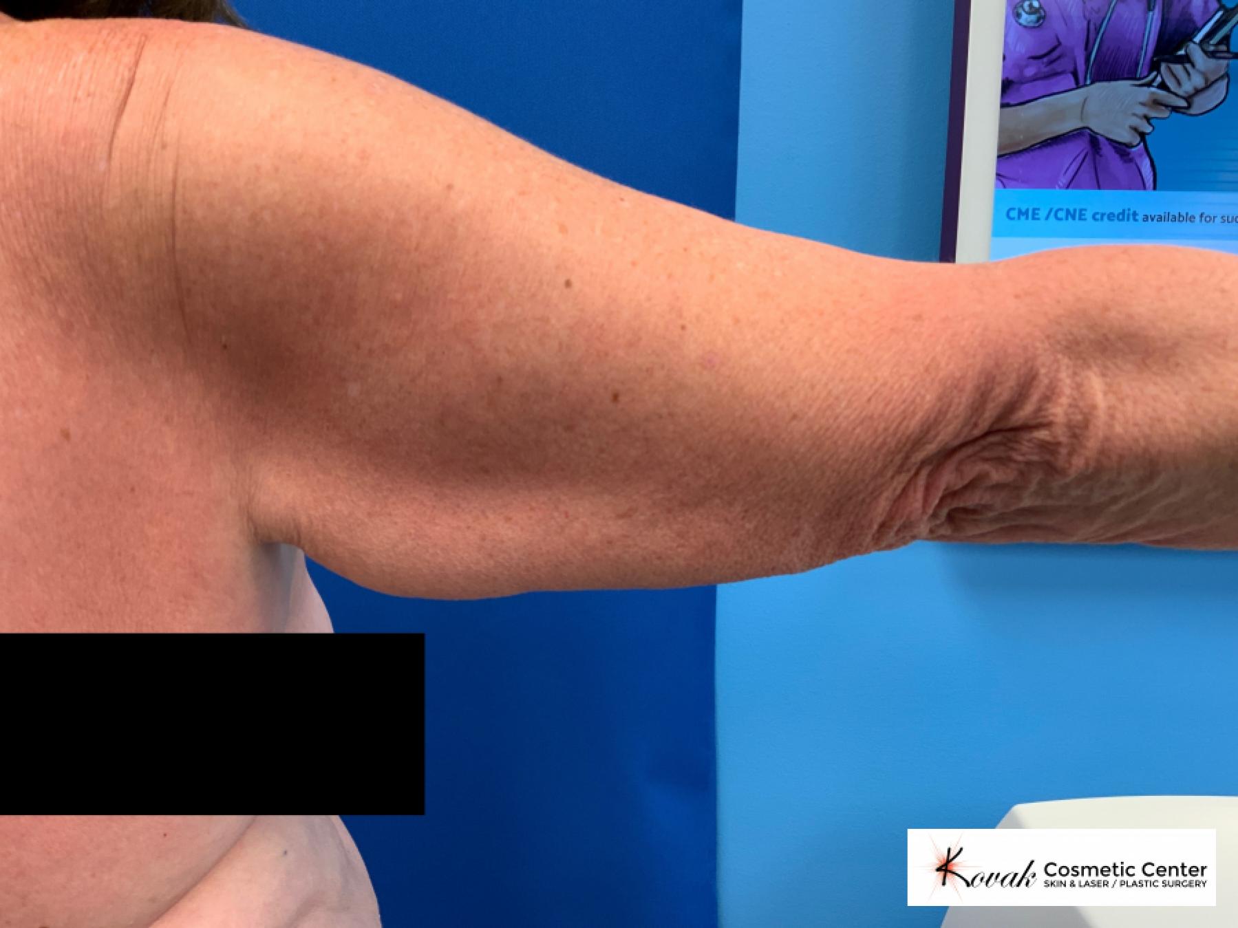 Laser Liposuction of the arms on a 69 year old female - Before 