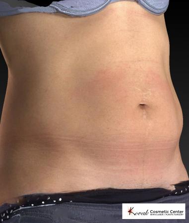 CoolSculpting®: Patient 6 - Before and After Image 5