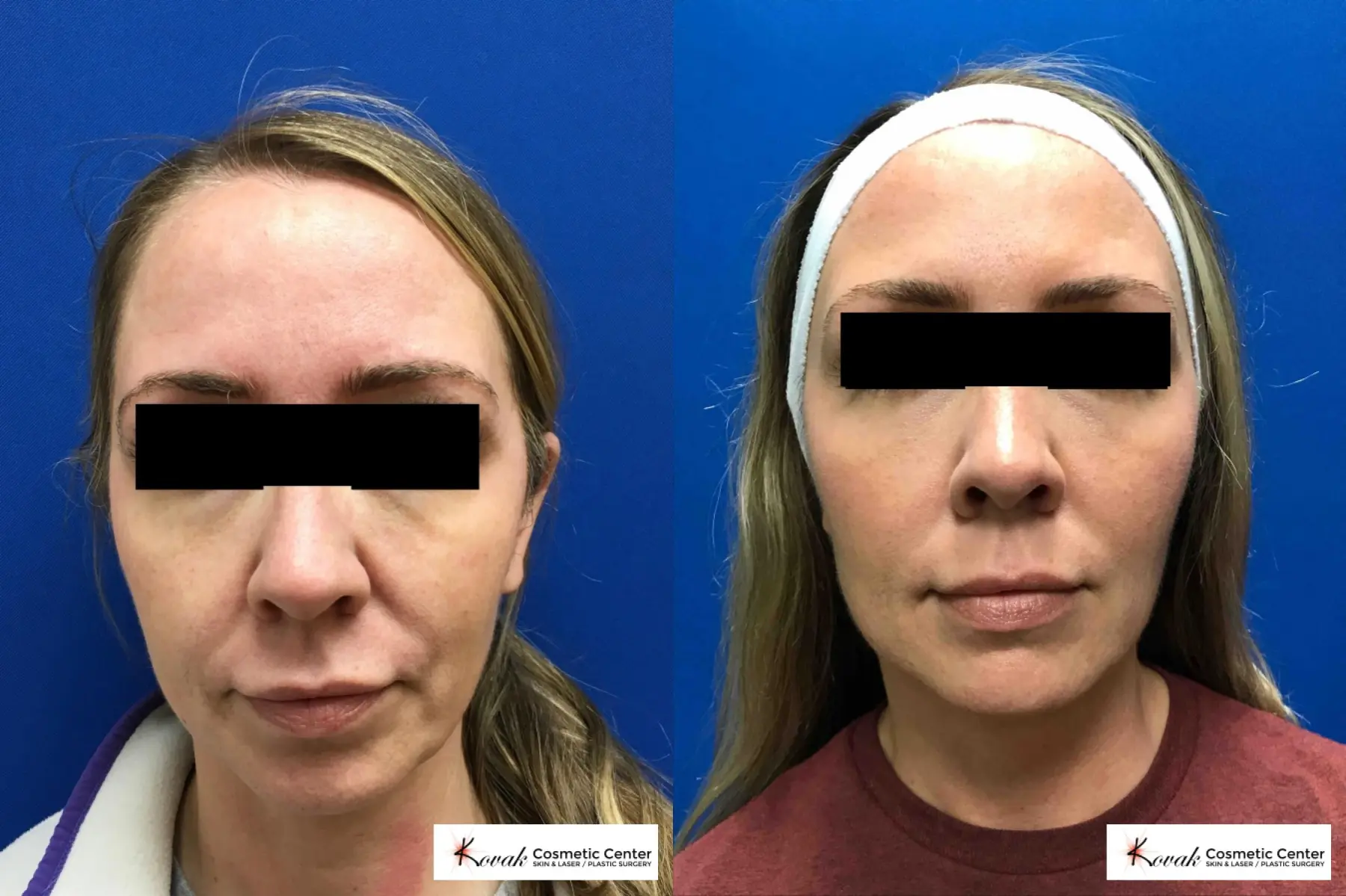 Sculptra®: Patient 5 - Before and After  