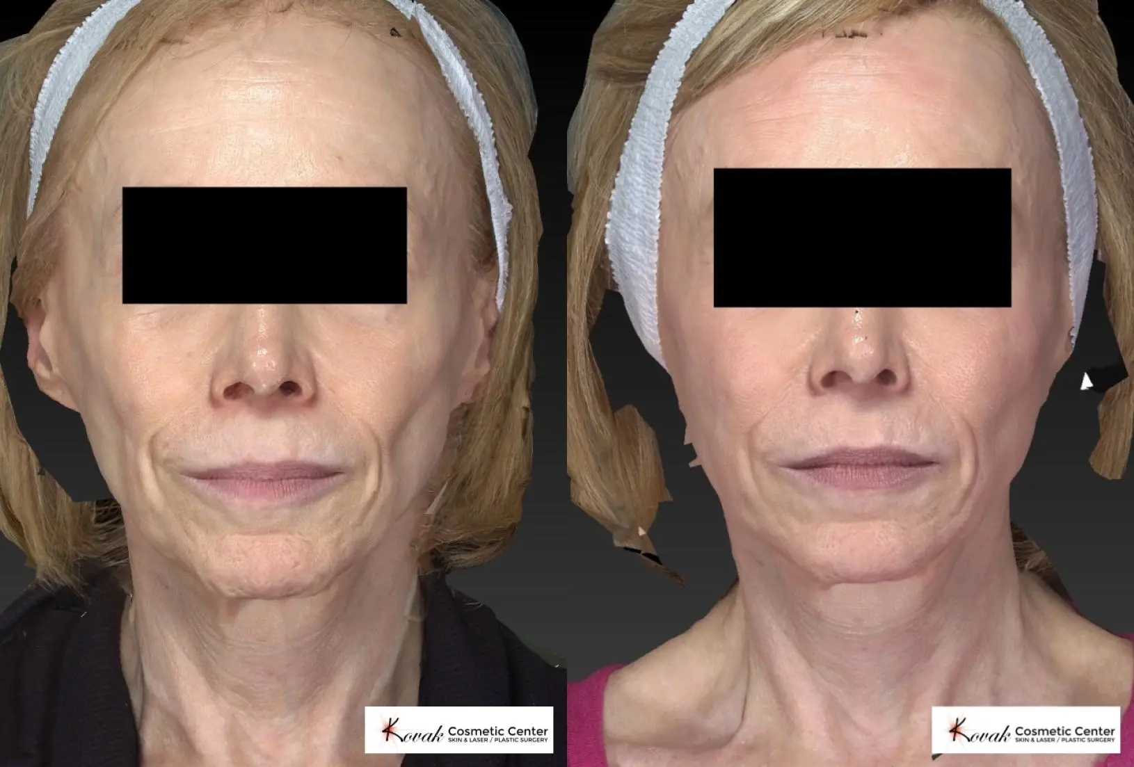 Sculptra®: Patient 1 - Before and After  