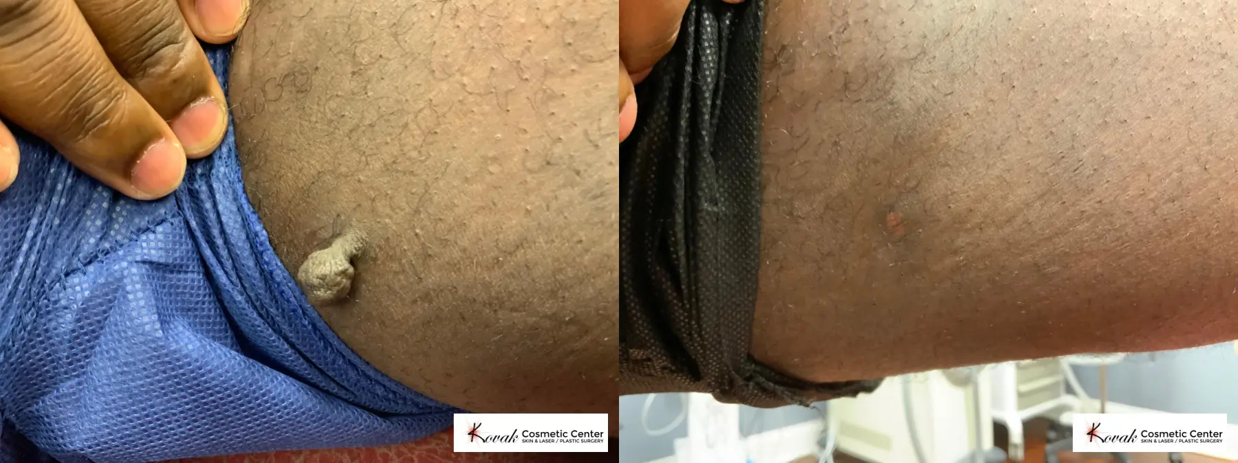 Skin Tag Removal on a 30 year old male - Before and After  