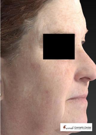 Halo™: Patient 1 - Before and After 3