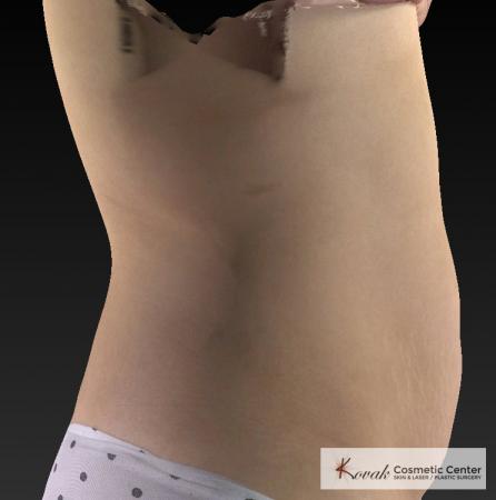 CoolSculpting®: Patient 26 - After