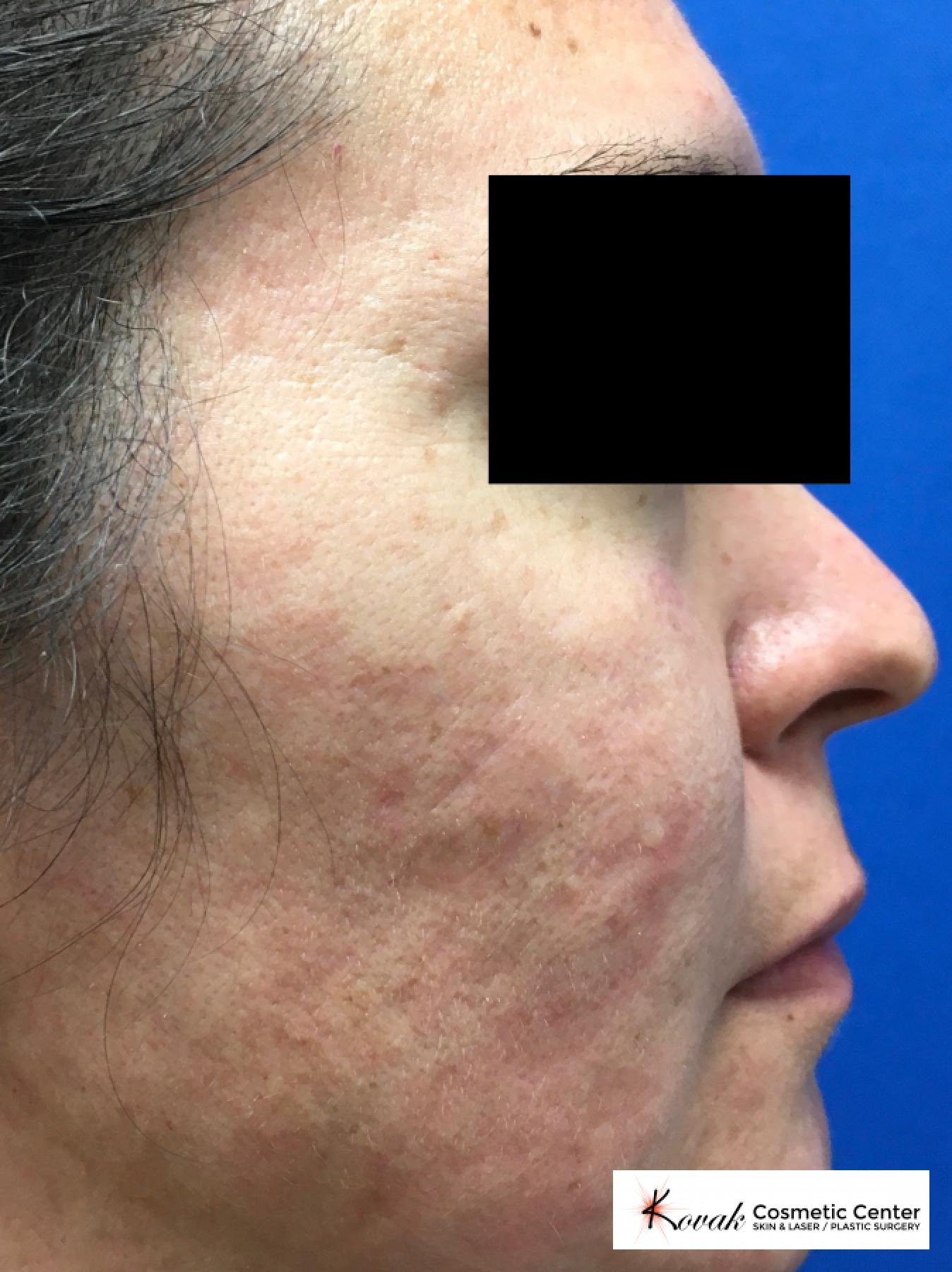 Filler for Acne Scars using Juvederm on a 32 year old female - After  