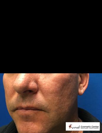 Juvéderm® XC: Patient 1 - After 2