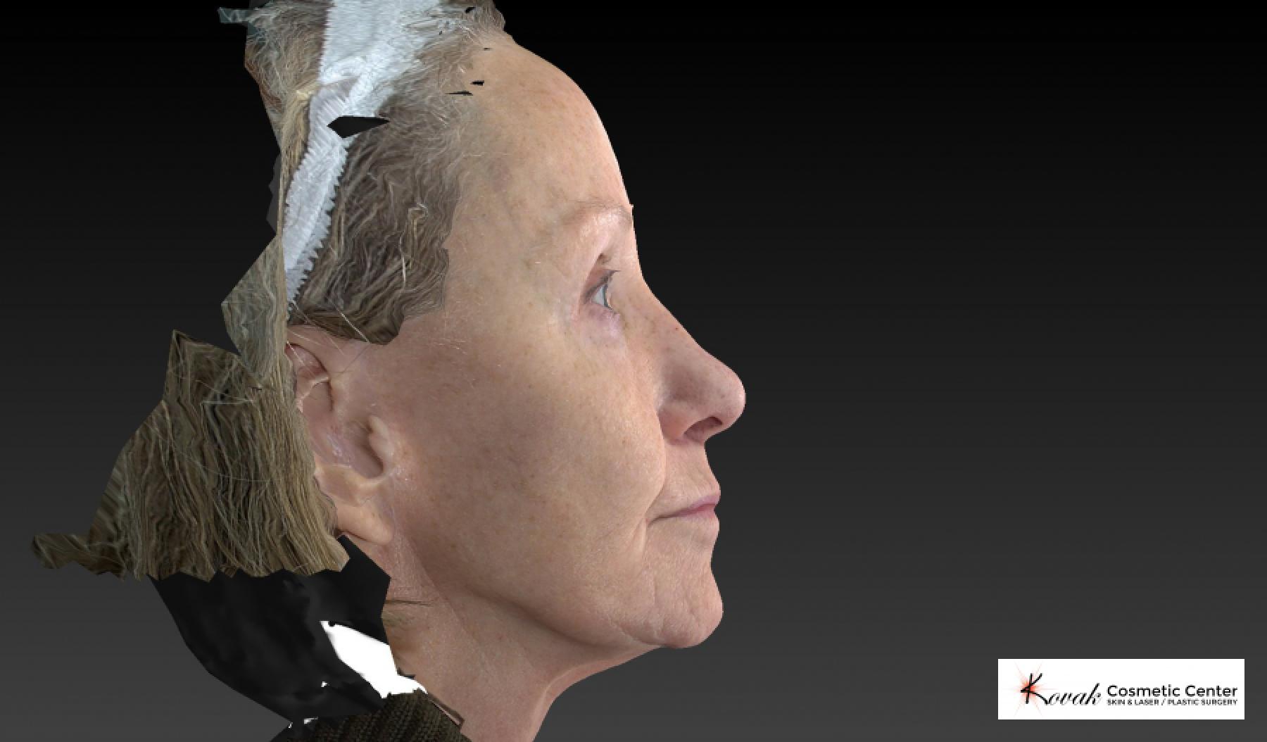 Halo™: Patient 2 - Before 