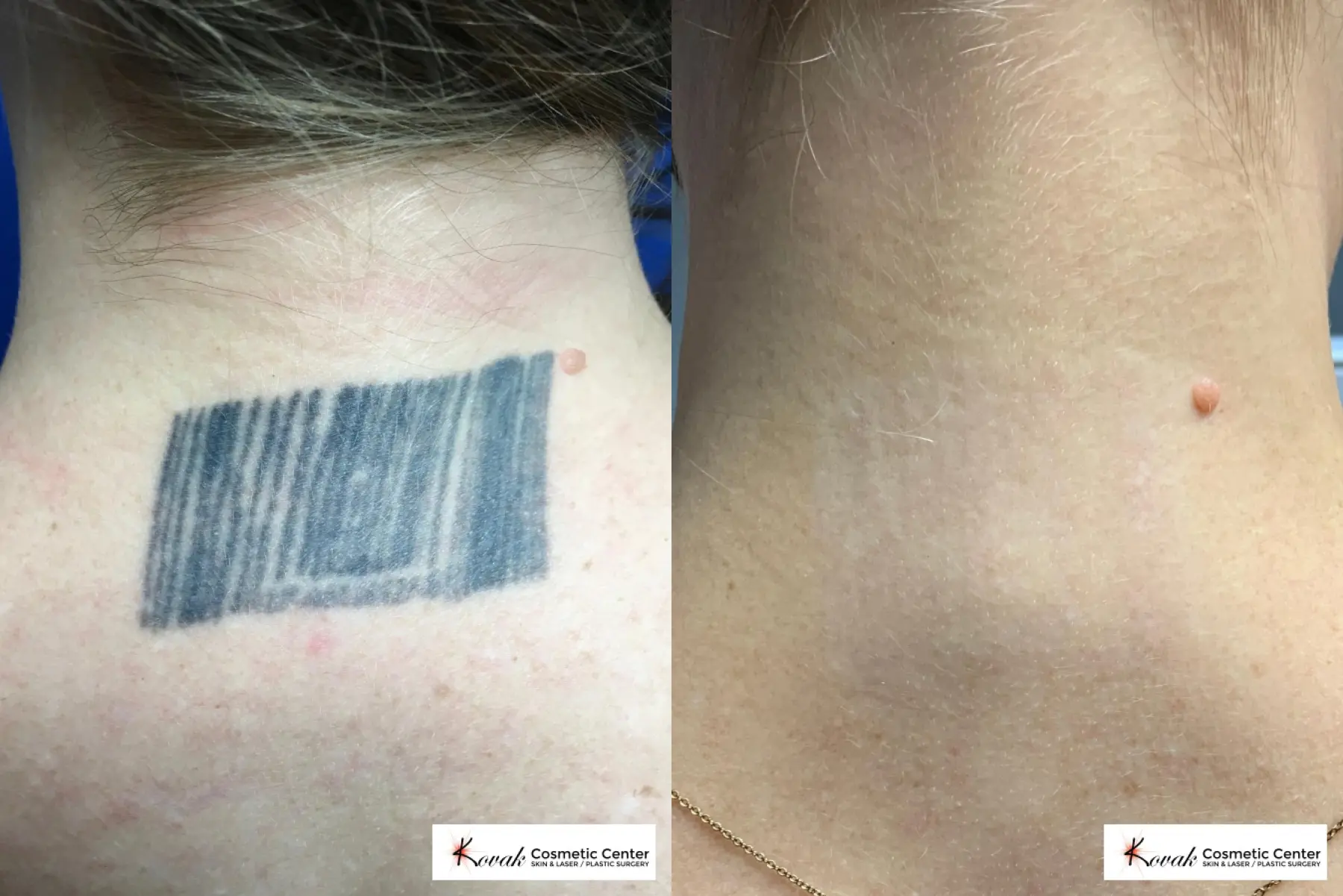Tattoo removal on a 36 yr old female using the picoway laser  - Before and After  
