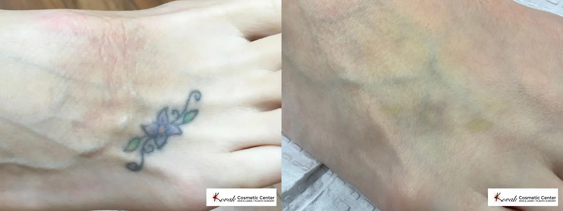 Tattoo Removal on a 39 year old woman - Before and After  