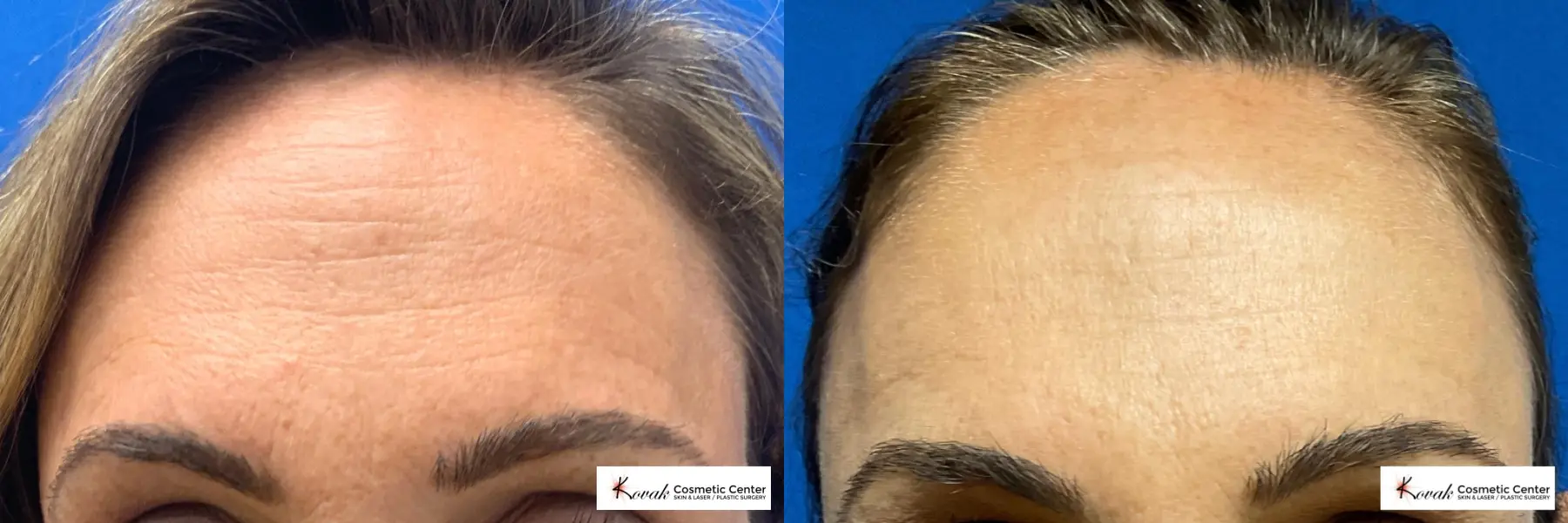 Threads on the forehead lines of a 47yr old female - Before and After  