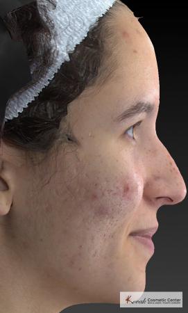 Venus Viva: Patient 3 - Before Image 1