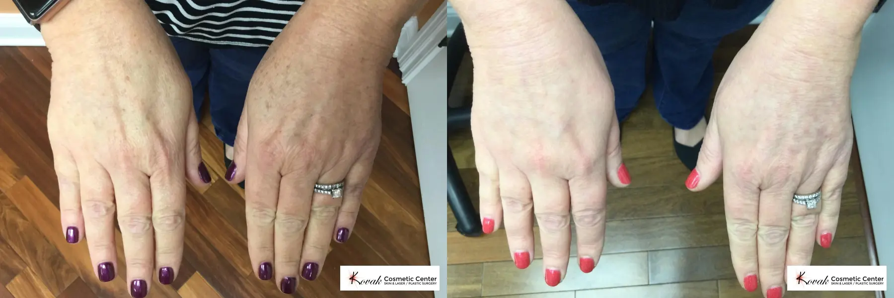 Photorejuvenation of the hands for brown spots on a 45 yr old female  - Before and After  
