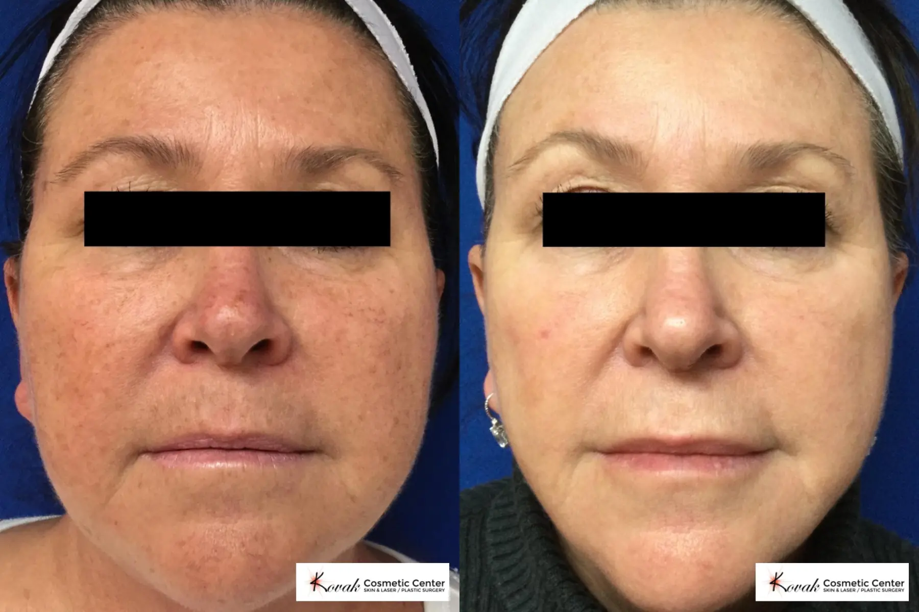 Photorejuvenation on the face of a 59 yr olde female  - Before and After  