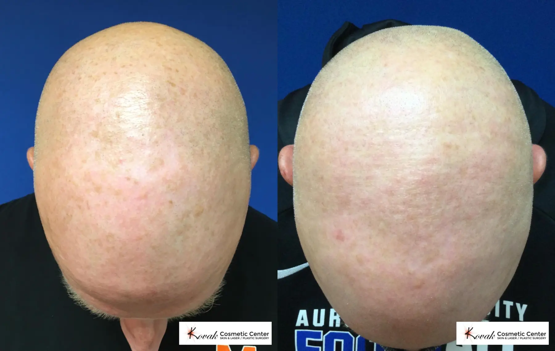 Tyte and Bryte Photorejuvenation on a 46 year old male - Before and After  