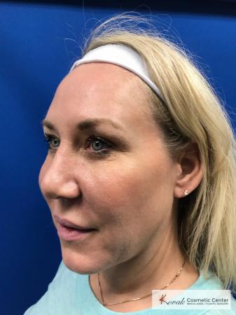 Neck Lift: Patient 3 - Before and After 2
