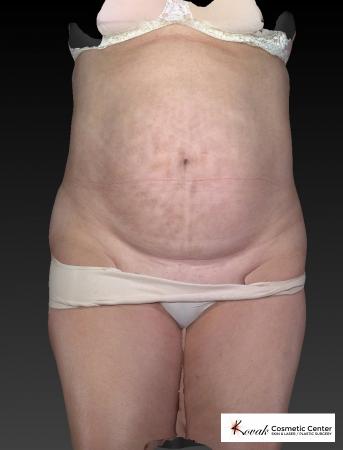 CoolSculpting®: Patient 11 - After 1
