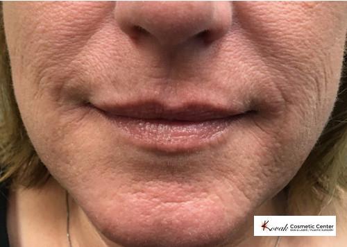 Restylane® Silk: Patient 5 - Before 