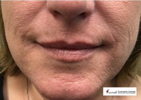 Restylane® Silk: Patient 5 - Before 1