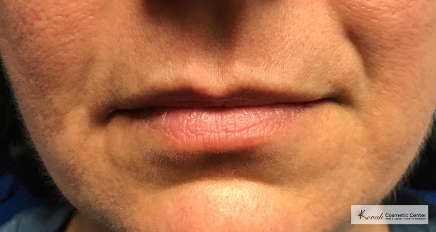 Juvéderm® XC: Patient 8 - Before 