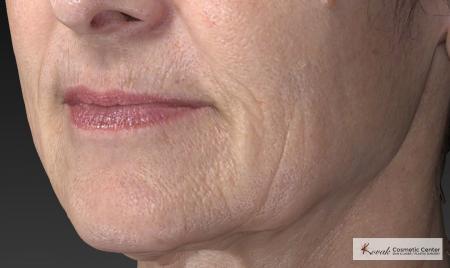 Injectables - Mouth: Patient 8 - Before Image 4