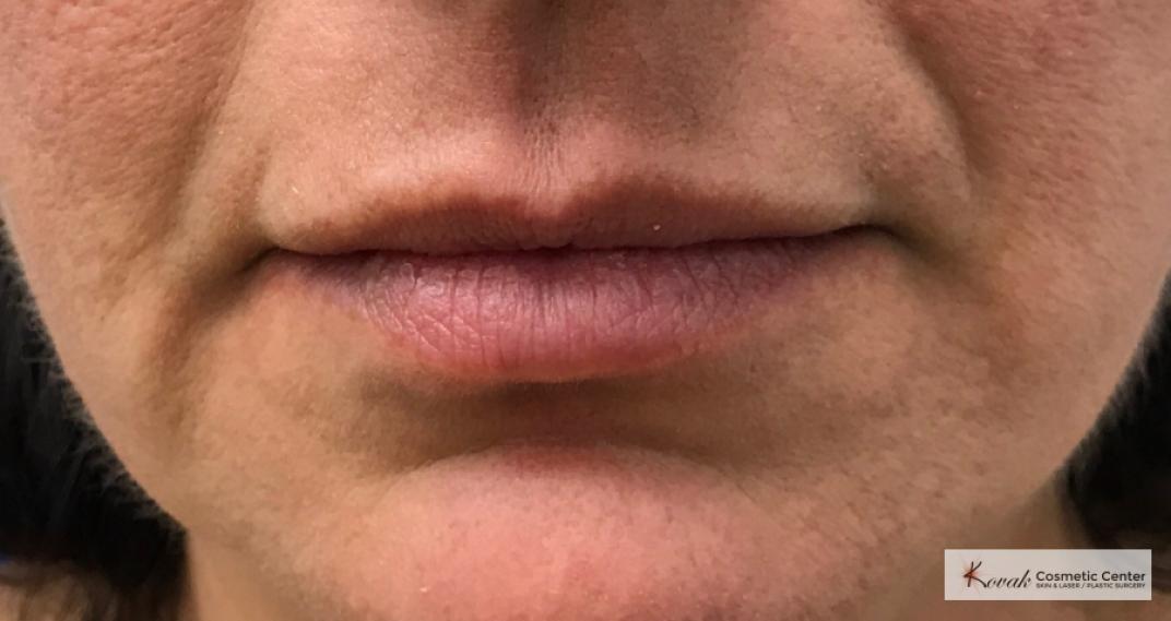 Juvéderm® XC: Patient 8 - After  