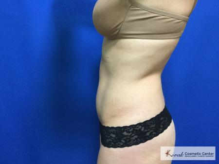CoolSculpting®: Patient 17 - After 2