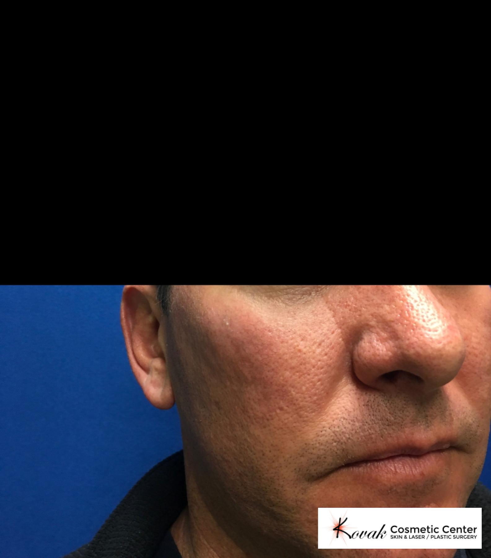 Juvéderm® XC: Patient 1 - After  
