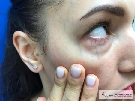 Eye Vein Treatment: Patient 3 - Before Image 1