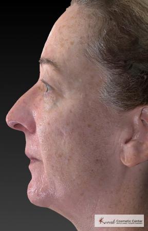 Tyte And Bryte – Face: Patient 6 - Before Image 3