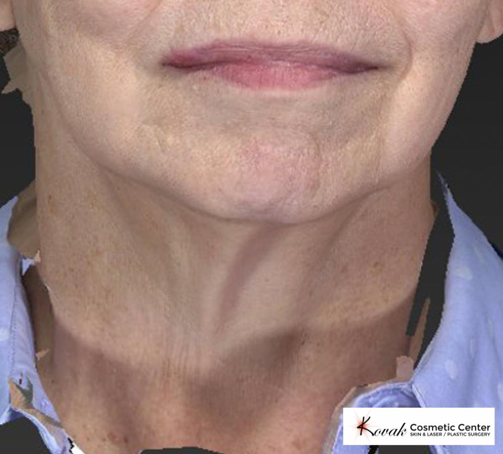 CoolSculpting®: Patient 6 - After  