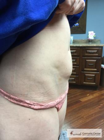 Laser Liposuction of the abdomen on a 28 year old female - Before and After 2