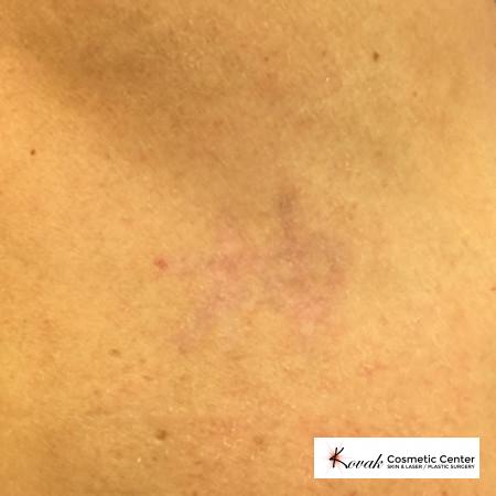 Tattoo Removal: Patient 2 - After  