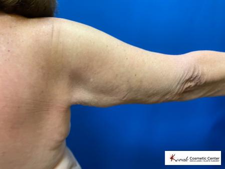 Laser Liposuction of the arms on a 69 year old female - After  
