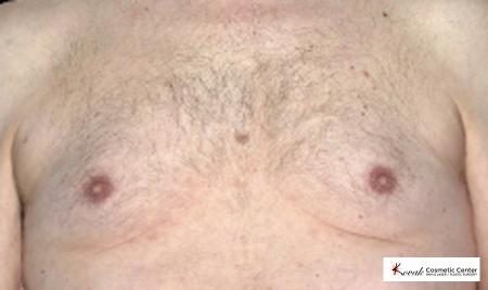 CoolSculpting®: Patient 7 - Before 
