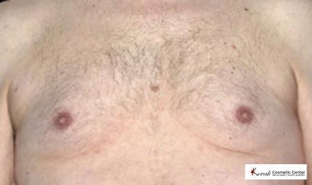 CoolSculpting®: Patient 7 - Before 1