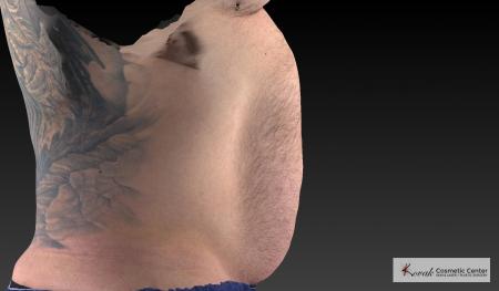 CoolSculpting®: Patient 20 - After 1