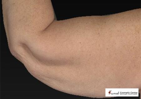 CoolSculpting®: Patient 14 - After
