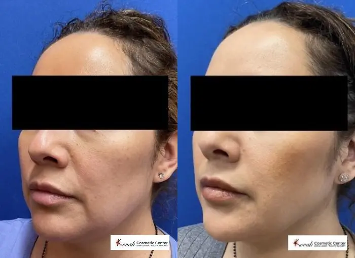 VLR - Vaser Laser - Jawline Sculpting: Patient 5 - Before and After  