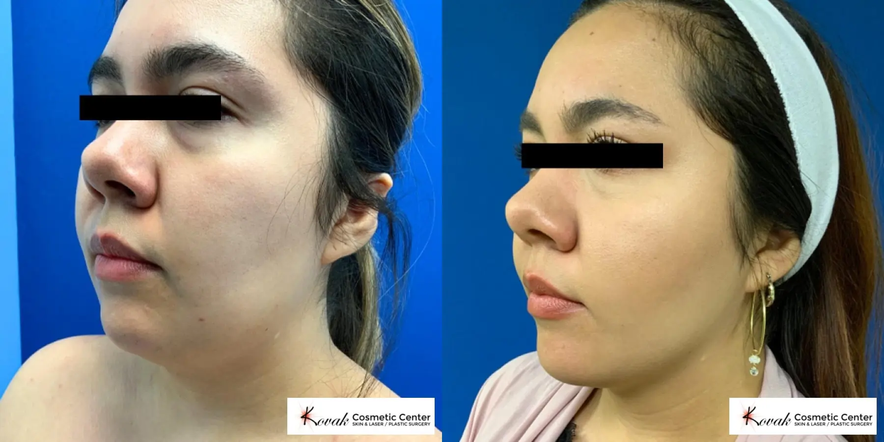 VLR - Vaser Laser - Jawline Sculpting: Patient 12 - Before and After 1