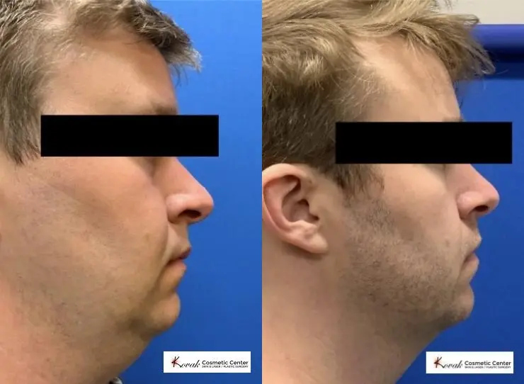 VLR - Vaser Laser - Jawline Sculpting: Patient 3 - Before and After 2