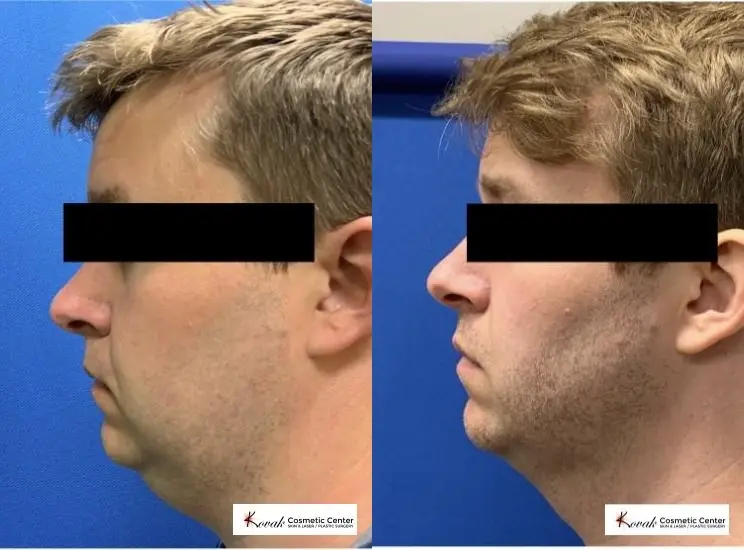 VLR - Vaser Laser - Jawline Sculpting: Patient 3 - Before and After  