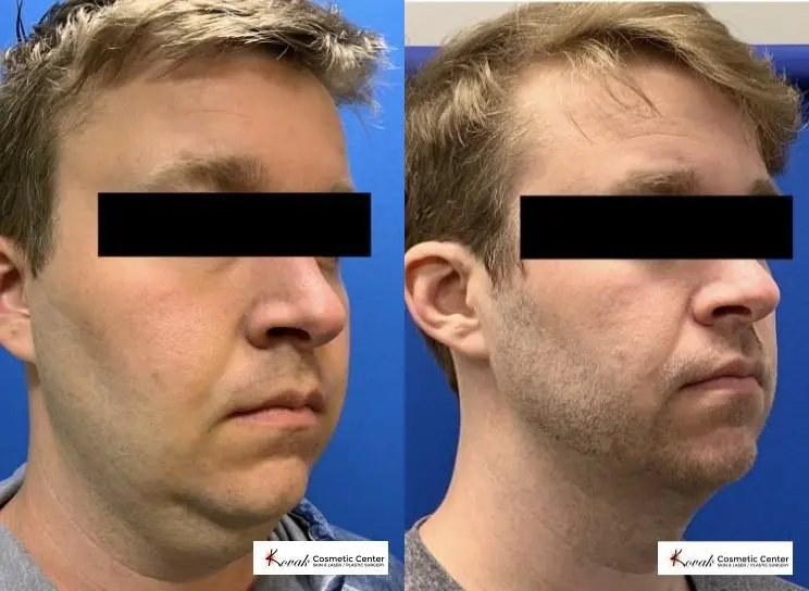 VLR - Vaser Laser - Jawline Sculpting: Patient 3 - Before and After 5