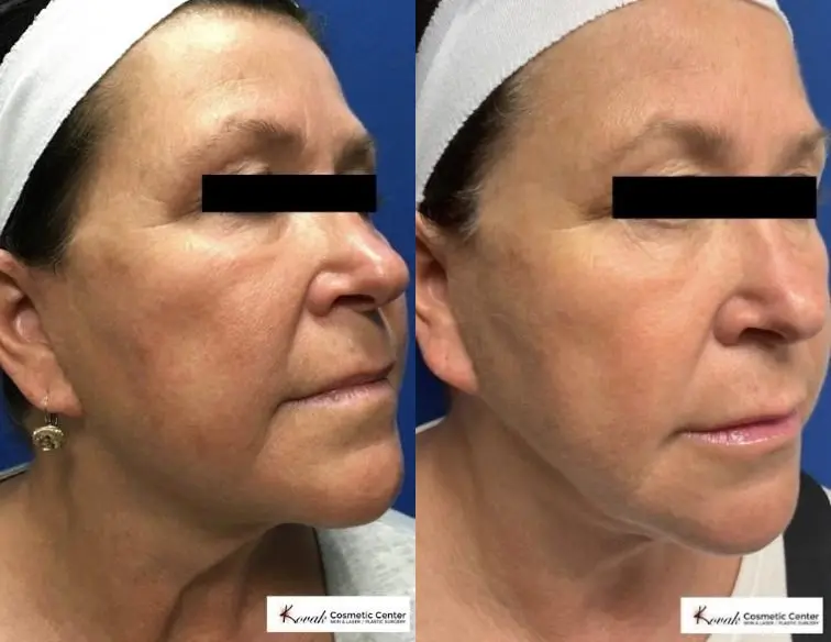 VLR - Vaser Laser - Jawline Sculpting: Patient 4 - Before and After  