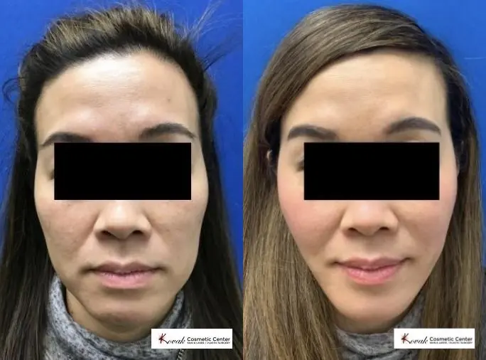 VLR - Vaser Laser - Jawline Sculpting: Patient 6 - Before and After  