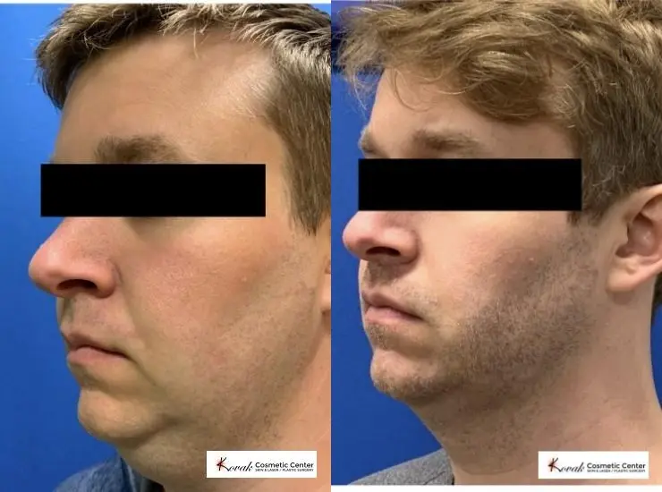 VLR - Vaser Laser - Jawline Sculpting: Patient 3 - Before and After 4