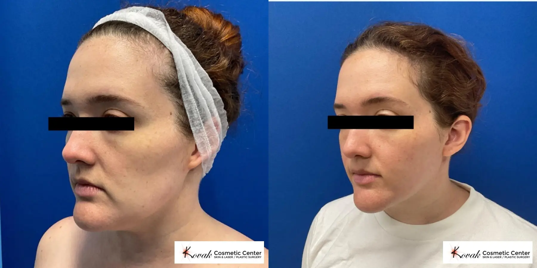 VLR - Vaser Laser - Jawline Sculpting: Patient 14 - Before and After 2
