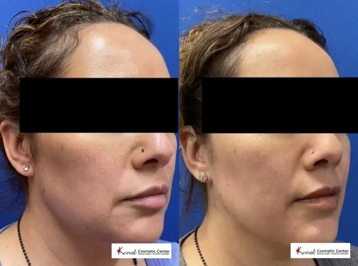VLR - Vaser Laser - Jawline Sculpting: Patient 5 - Before and After 2