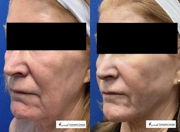 VLR - Vaser Laser - Jawline Sculpting: Patient 8 - Before and After  
