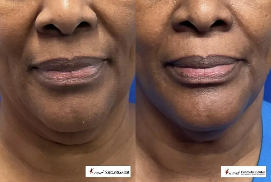 VLR - Vaser Laser - Jawline Sculpting: Patient 2 - Before and After 2