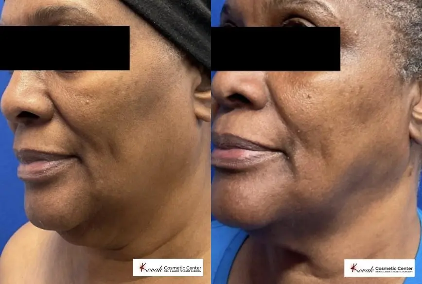 VLR - Vaser Laser - Jawline Sculpting: Patient 2 - Before and After  